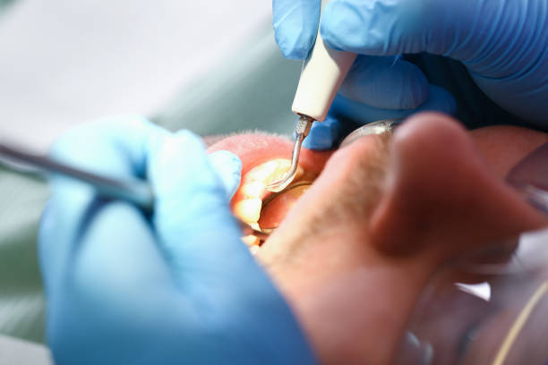 Best Knocked-Out Tooth (Avulsed Tooth) Treatment in Balcones Heights, TX