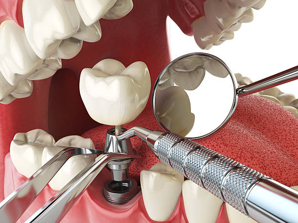 Best Broken or Chipped Tooth Repair in Balcones Heights, TX